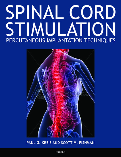spinal cord stimulator implant reviews