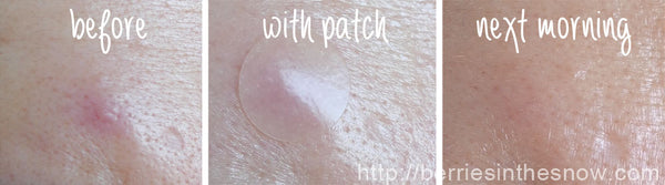 acne pimple master patch review