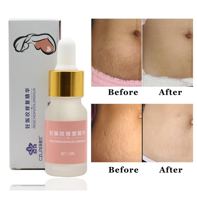 bio oil for stretch marks after pregnancy reviews